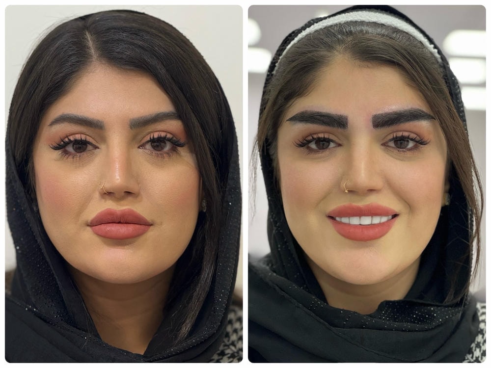 نتیجه مزوتراپی