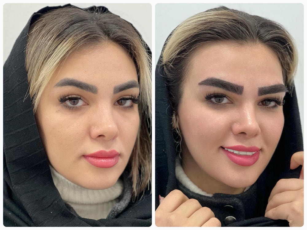 نتیجه لیفت صورت