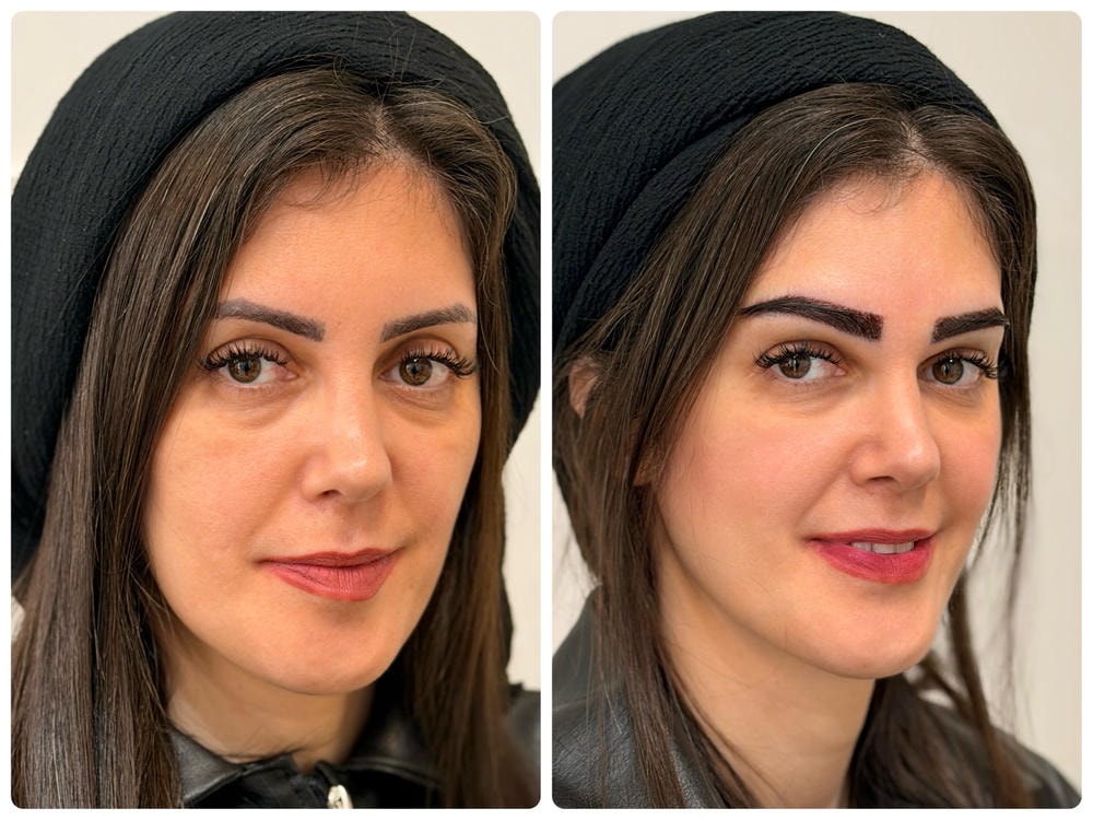 نتیجه میکرونیدلینگ