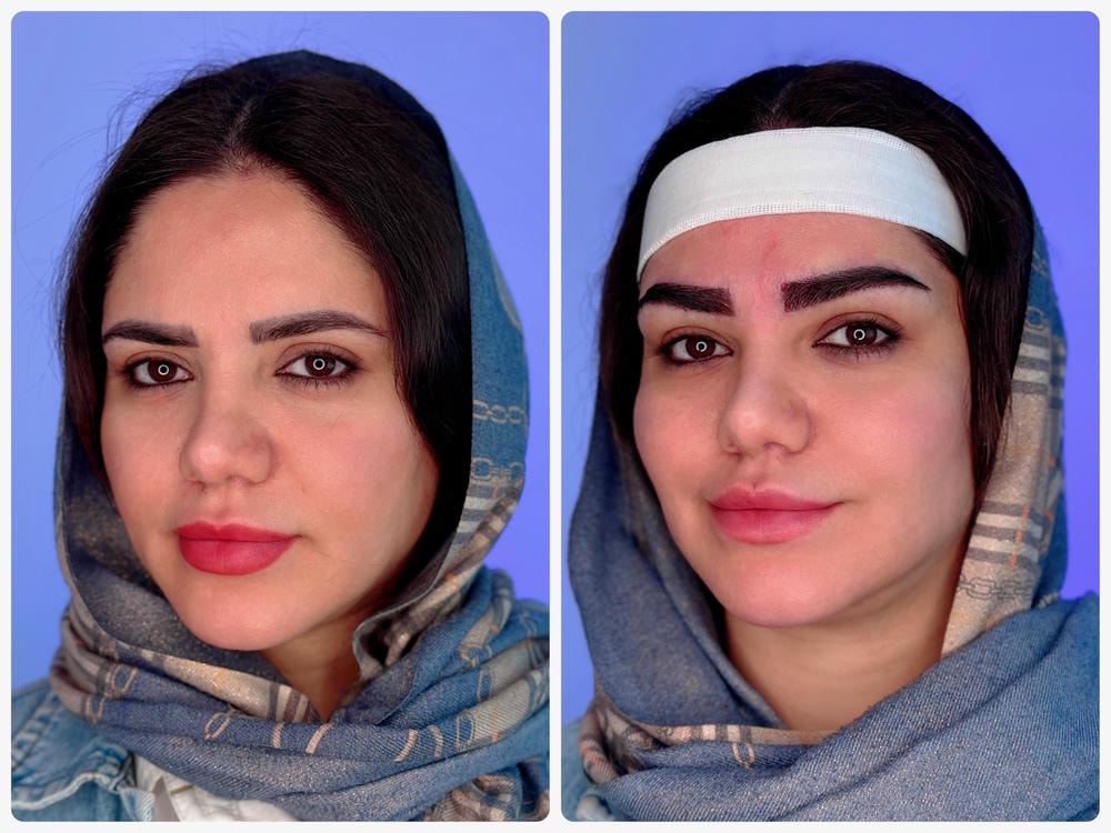 نتیجه رفع تیرگی