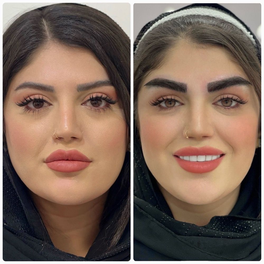 کاشت ابرو